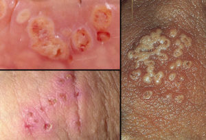 Herpes-Symptoms-For-males